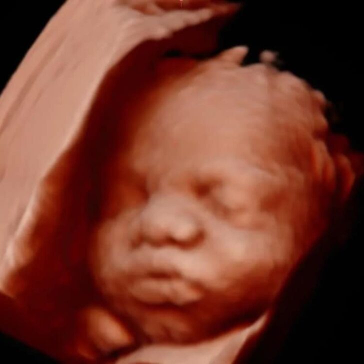 Ultrasound image showcasing baby's facial profile with prominent lips